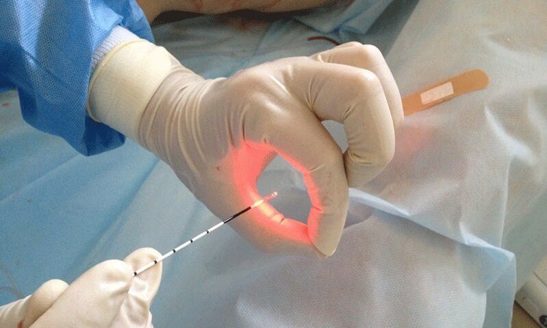 Laser Behandlung fir Prostatitis