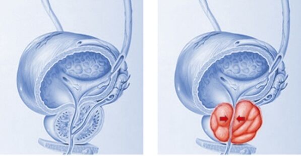 gesond an entzündete Prostata mat Prostatitis